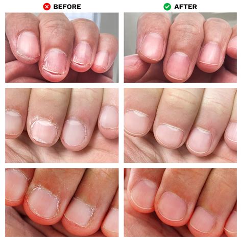 No Bite Nail Recovery | Nail Care | LONDONTOWN Kur