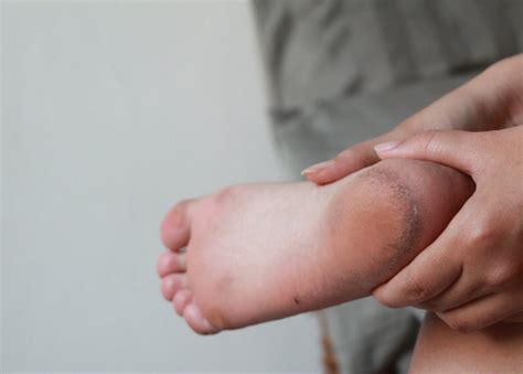 Understanding Urea Cream: Benefits, Application, and Ingredients