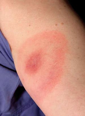 West Nile Virus Symptoms