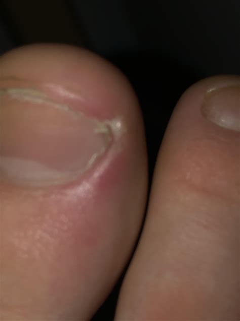 Is this in grown it really hurts on the right side : r/Ingrown_Toenails
