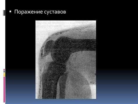 Дерматомиозит (Полимиозит) - презентация онлайн