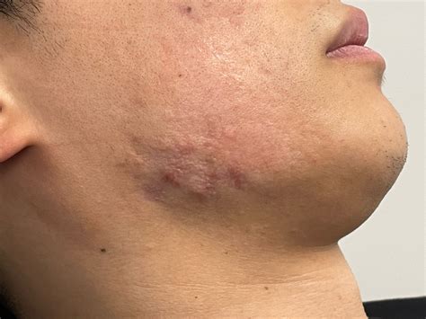 Steroids For Acne Skin at Lauren Murphy blog