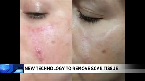 scar tissue removal