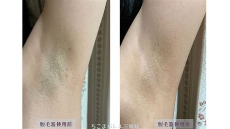 【バレエレッスン時の脇毛処理方法】小中学生から大人の方までピッタリなムダ毛処理方法を解説｜ちこまバレエ三姉妹