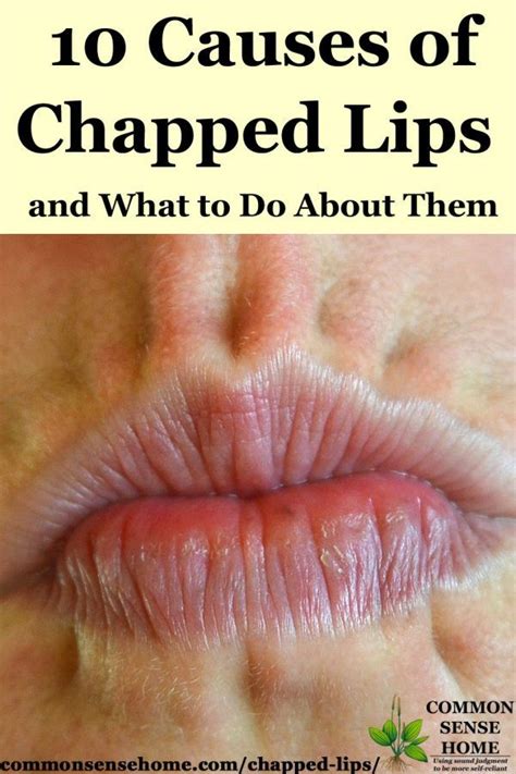 10 Chapped Lips Causes, Plus How to Get Rid of Chapped Lips | Dry lips ...