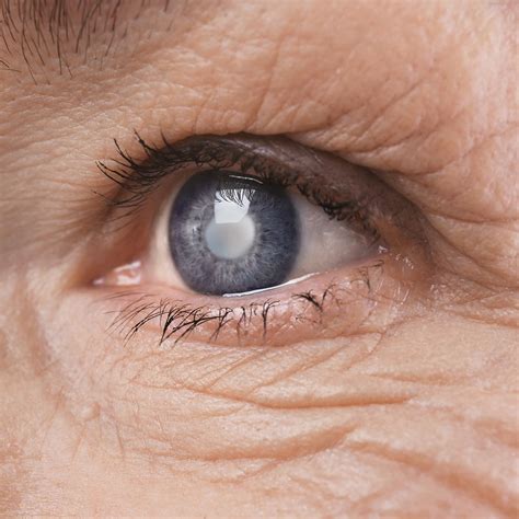 glaucoma  micro invasive glaucoma surgery