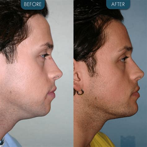 Chin implant Before and After - Zaren Health