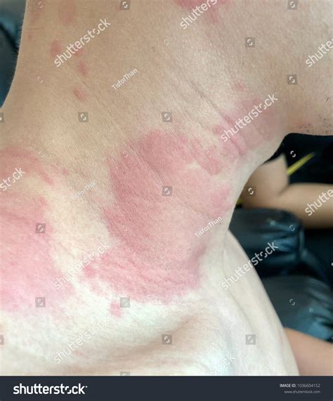 97 Urticarial Rash Royalty-Free Images, Stock Photos & Pictures