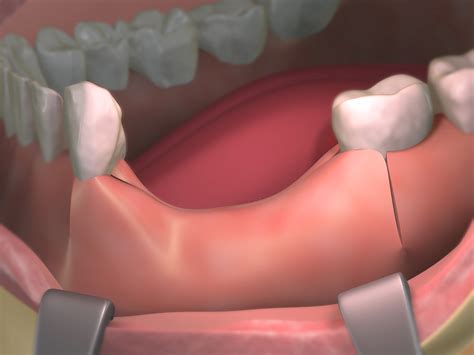 Bone Grafting - Sparacino Periodontics