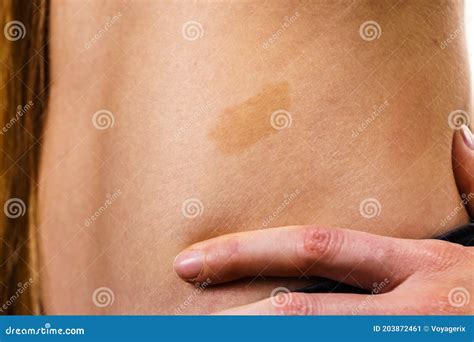 Mancha De Nascença Marrom Claro - Vestimenta Da Marca De Nascença Marrom Na Pele Imagem de Stock - Imagem ...