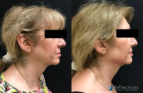 jawline fillers   results  skinly