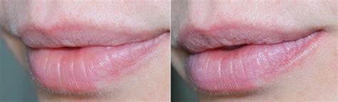 Cicaplast Antes E Depois Cicatriz - Resenha: Cicaplast Baume B5 La Roche PosayEu vou de Rosa- Cabelos e ...