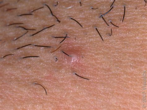ingrown hairs  ways  prevent  goodrx