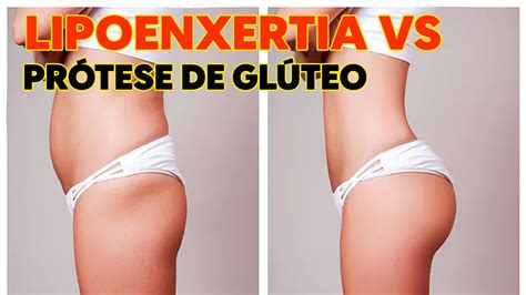 Lipo Com Enxerto No Gluteo Antes E Depois - Implantes Bumbum Para Cirurgia Plastica Silicone Nos Glúteos: