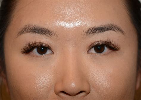 Patient #1454 - Amadi Aesthetics | Plastic Surgery & Med SPA