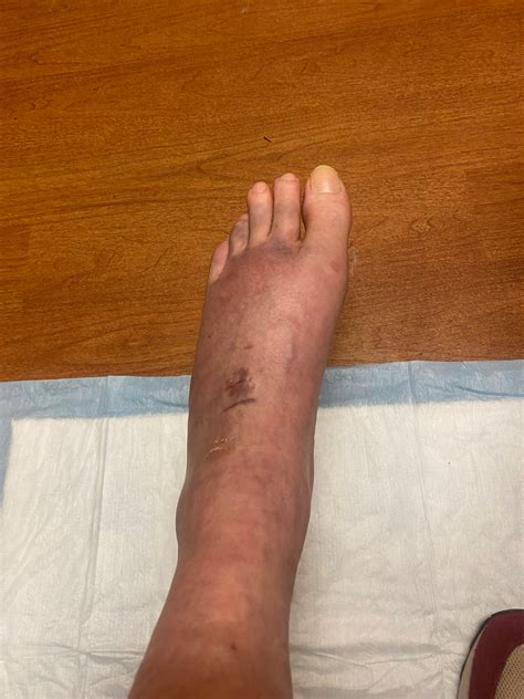 Fundraiser by Elton Ivanoff : Support Elton’s Recovery After Injury