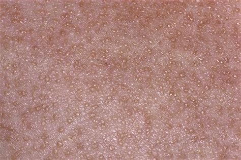 Papular Sarcoidosis