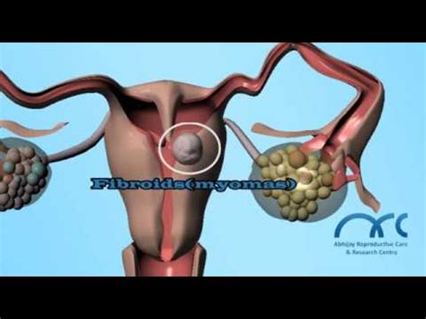 Hysterosalpingogram Procedure | Hysterosalpingogram Video - ARC Chennai ...