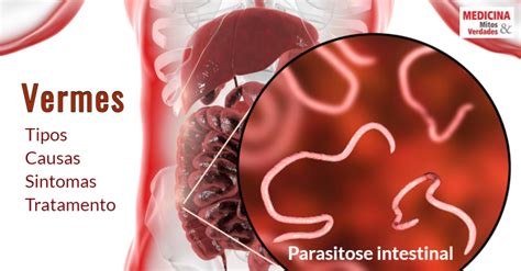 Tipos de vermes intestinais: causas, sintomas e tratamento | Medicina ...