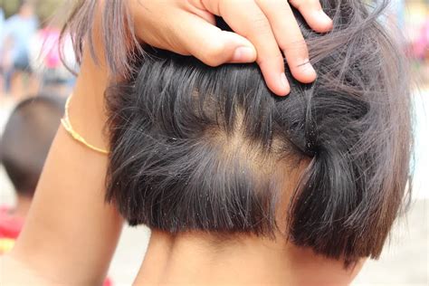 What Do Head Lice Eat? | LiceDoctors