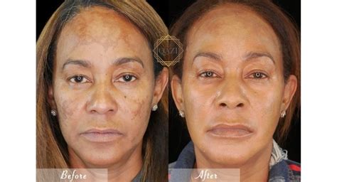 black people acne scars