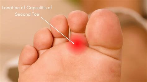 Capsulitis of the Second Toe: Symptoms, Causes & Treatment