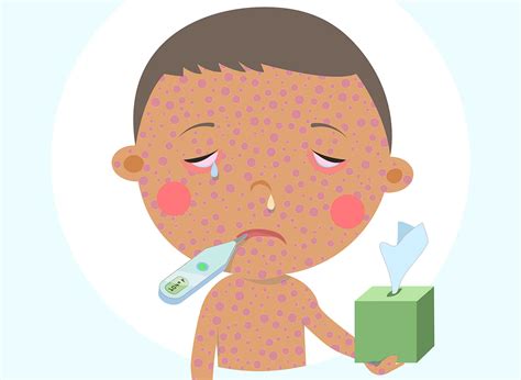 measles symptoms - Clip Art Library