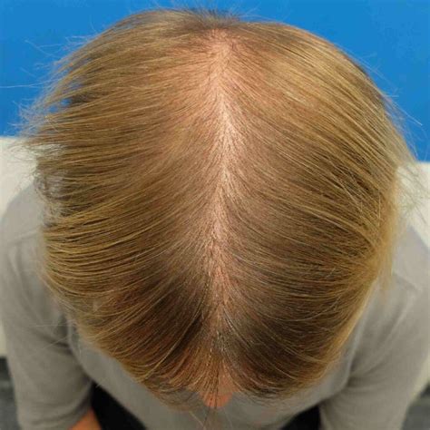 Hair Plugs Versus A Modern Hair Transplant