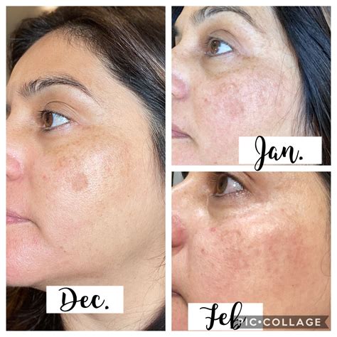face desonide cream before and after 1