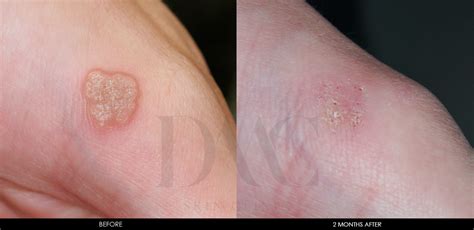 Wart Removal - DMC Skin Clinic