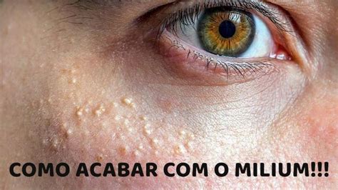 Bolinhas De Agua No Rosto - ACABA COM AS BOLINHAS NO ROSTO ABAIXO DOS OLHOS | Bolinhas no rosto ...