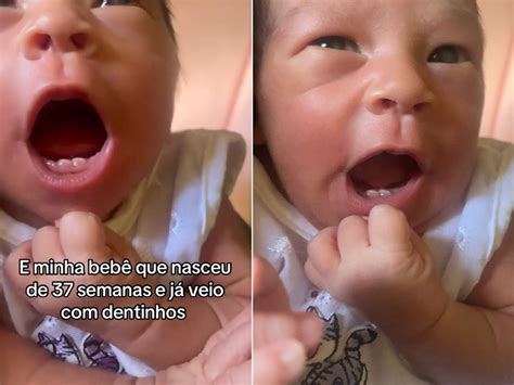 Bebê surpreende ao nascer com dois dentinhos, em MS. Entenda