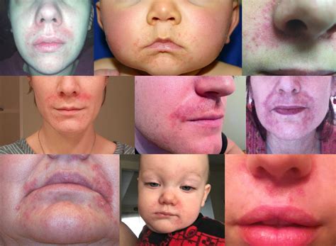 Six Steps For Healing Perioral Dermatitis