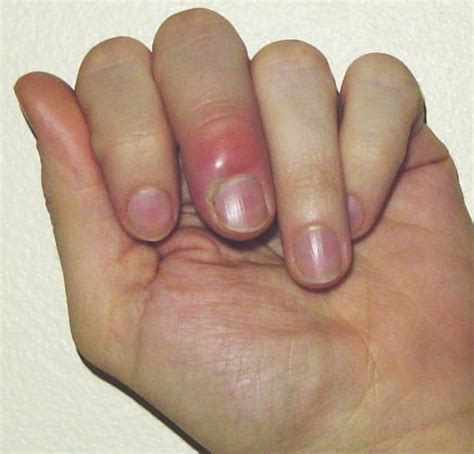 Hand and Finger Infections - Richard Stephen Gilbert, M.D.