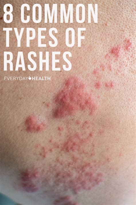 common torso rashes skin rash pictures types  treatment