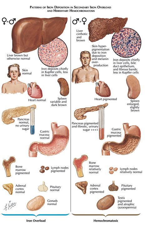 Hemochromatosis Bronze Skin