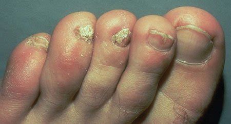 Fungal Infections of the Skin