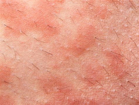 Lamictal Skin Rash May Be an Early Sign of Something Worse