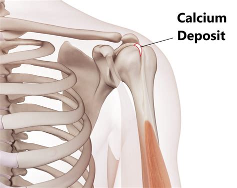 Torn Tendon In Upper Arm