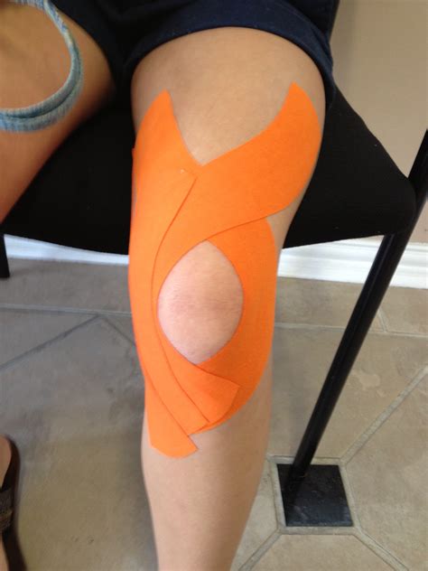 Patellofemoral Pain Syndrome Taping - Pregnancy Informations