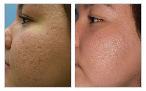 halo face treatment 2
