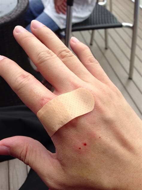 Dog Bite Hand