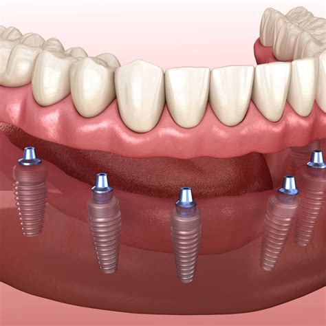 full mouth dental implants   premier dentistry