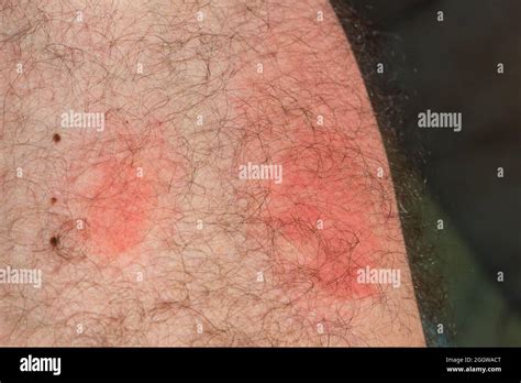 Wasp stings on skin after one day, red inflammation marks caused by ...