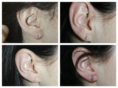 Mending The Tear: A Step-By-Step Guide To Repairing A Ripped Earlobe