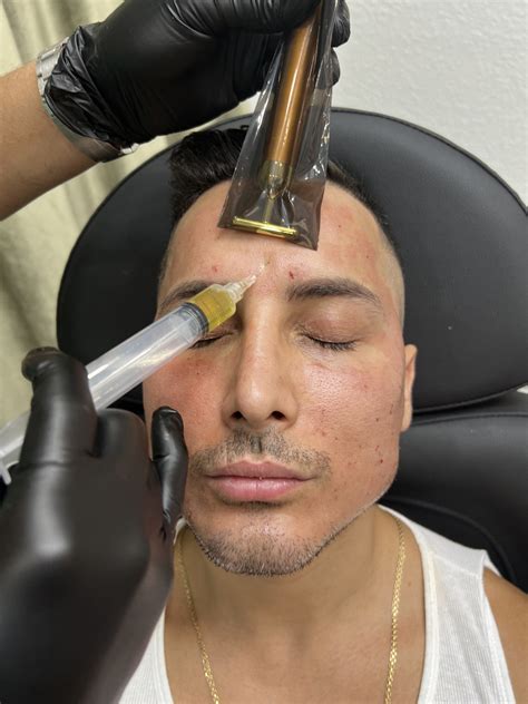 Platelet Rich Plasma Face | Galan Aesthetics