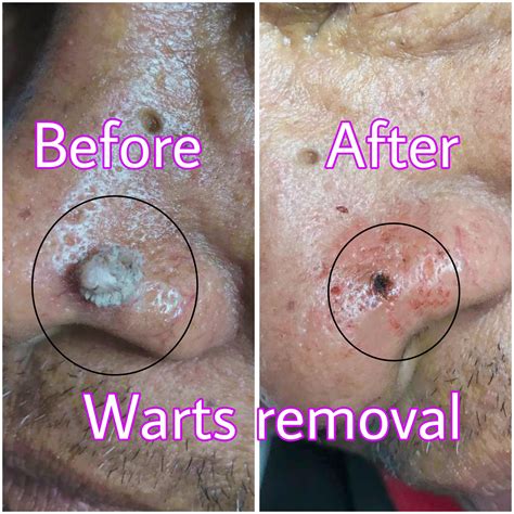 Dermaestetica - Warts removal naga Warts removal price start at 25