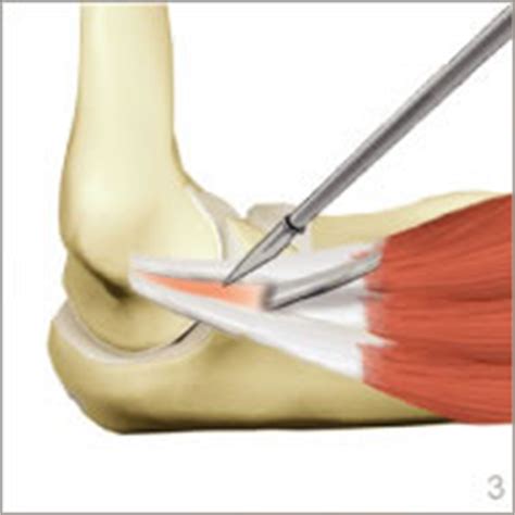 Traitement chirurgical des épicondylites du coude