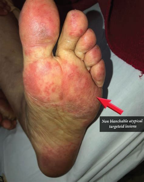 Lupus Rash On Hands Skin Papules, Hand Neuropathy And Monoclonal