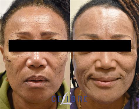 treatments celibre medical